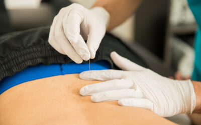 Functional Integrated Dry Needling